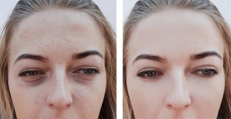 Tratamento a Laser para Acne Bela Cintra - Tratamento para Marcas de Acne