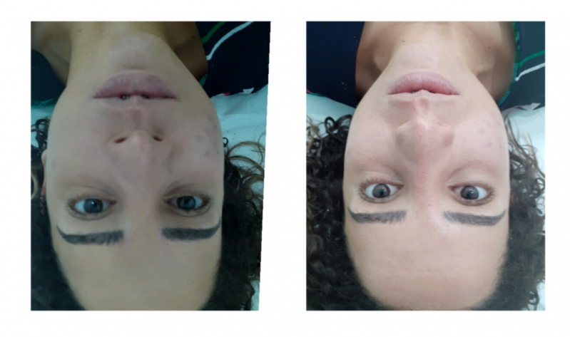 Tratamento Cicatriz Acne Agendar Vila Mariana - Tratamento a Laser para Acne