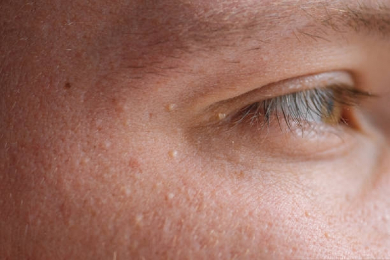 Tratamento de Pele para Milium Marcar Bela Cintra - Tratamento para Os Poros da Pele