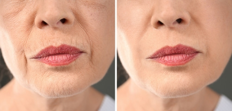 Tratamento de Preenchimento Labial Ana Rosa - Preenchimento Labial