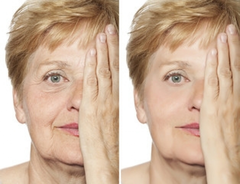 Tratamento de Preenchimento no Rosto Ana Rosa - Preenchimento nos Olhos