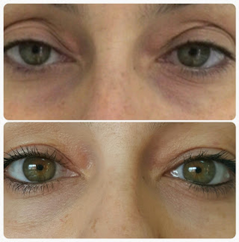 Tratamento de Preenchimento nos Olhos Higienópolis - Preenchimento na Testa