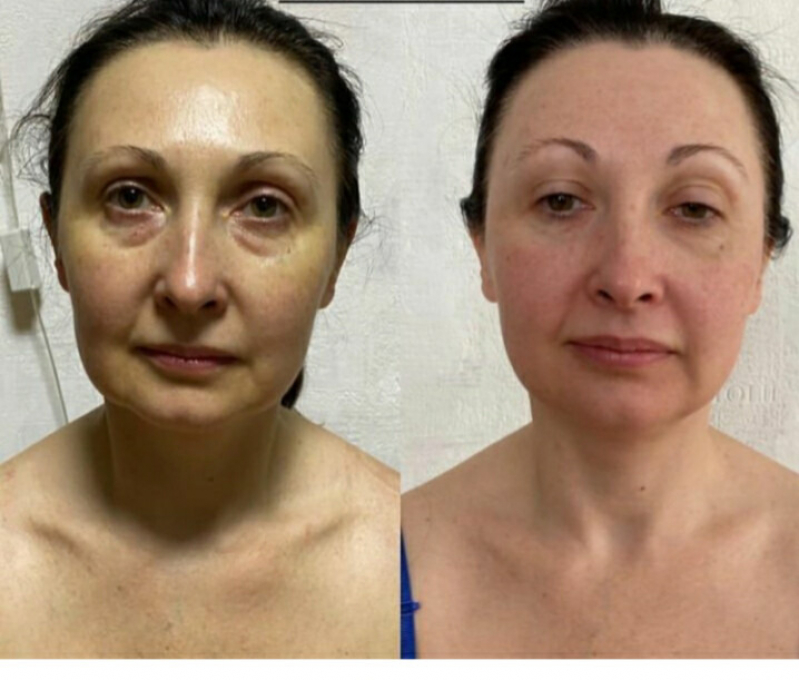 Tratamento de Rejuvenescimento Natural Bela Cintra - Rejuvenescimento Facial Natural
