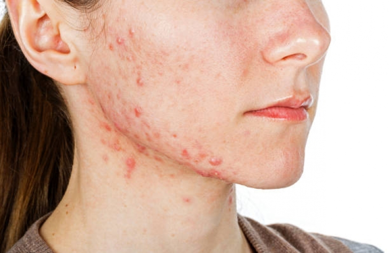 Tratamento para Cicatriz de Acne Ana Rosa - Tratamento para Acne e Manchas
