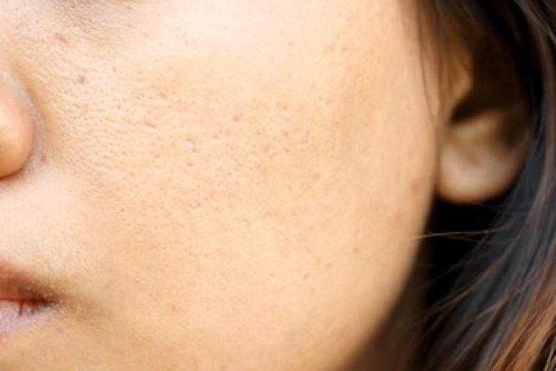 Tratamento para Manchas na Pele Vila Mariana - Tratamento para Os Poros da Pele