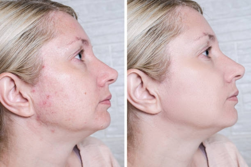 Tratamento para Marcas de Acne Agendar Consolação - Tratamento para Marcas de Acne