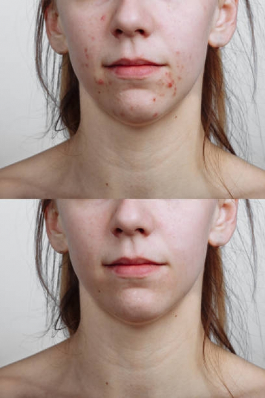 Tratamento para Marcas de Acne Consolação - Tratamento Cicatriz Acne