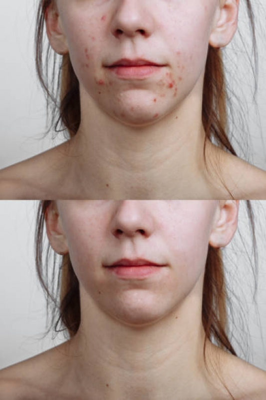 Tratamento para Marcas de Acne Praça Da Árvore - Tratamento para Cicatriz de Acne