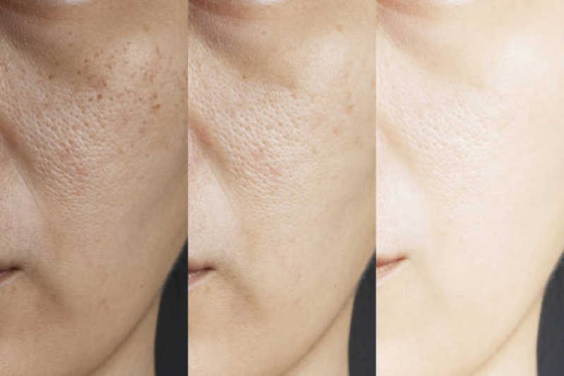 Tratamento para Os Poros da Pele Marcar Bela Cintra - Tratamento para Os Poros da Pele