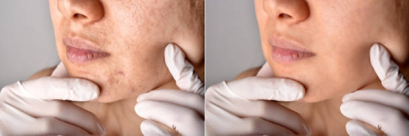 Tratamento para Os Poros da Pele Bela Cintra - Tratamento para Clarear a Pele