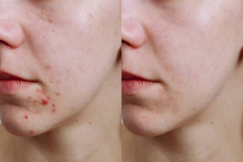Tratamentos para Cicatriz de Acne Ana Rosa - Tratamento para Acne Hormonal
