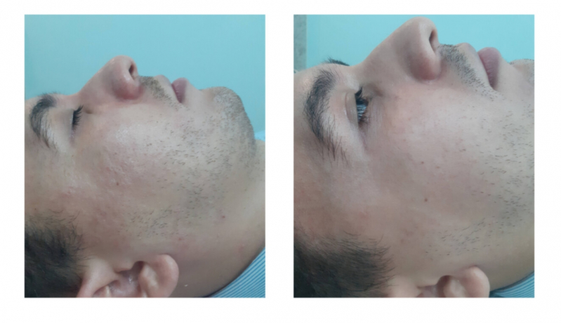 Tratamentos para Os Poros da Pele Bela Cintra - Tratamento para Clarear a Pele